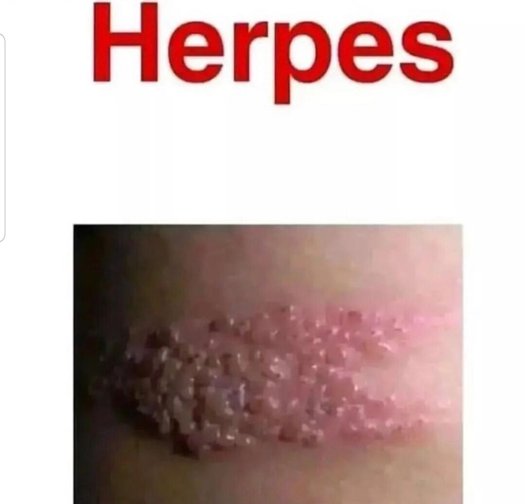 Herpes Can Be Eliminated Naturally with Herbal Medicine